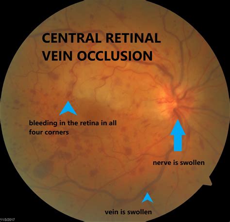 Discover How an Expert Optometrist Can Help You Find Relief from Central Retinal Vein Occlusion